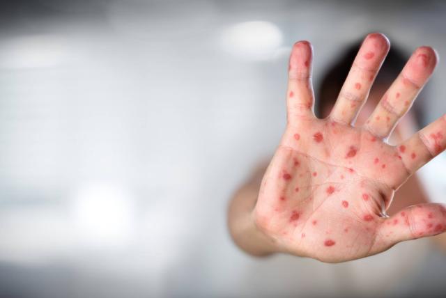 Monkeypox is Not a Gay Disease